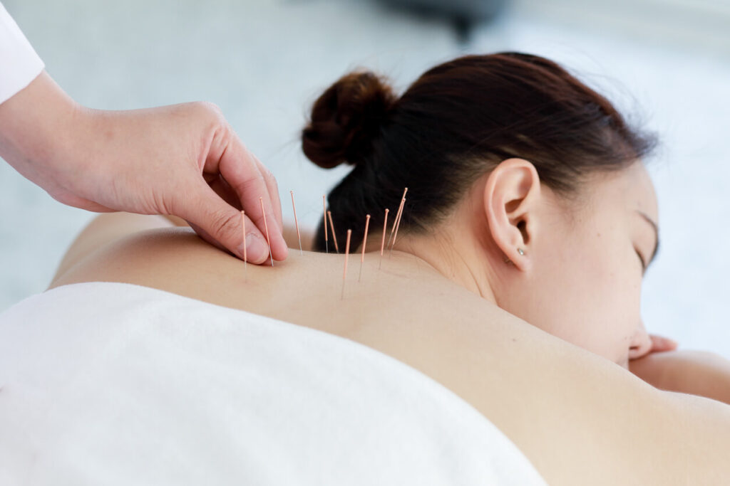 Hand of doctor performing acupuncture therapy