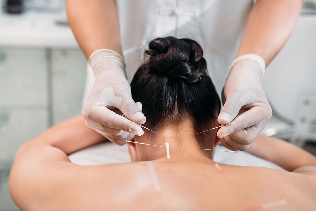 a cropped shot of an acupuncturist putting needles on a woman's body during acupuncture therapy.