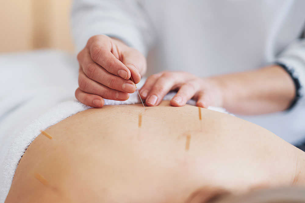 Acupuncturist Salaries in the United States: Income and Career Outlook