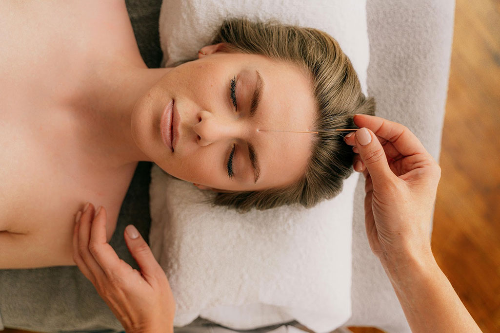 Woman getting facial acupuncture