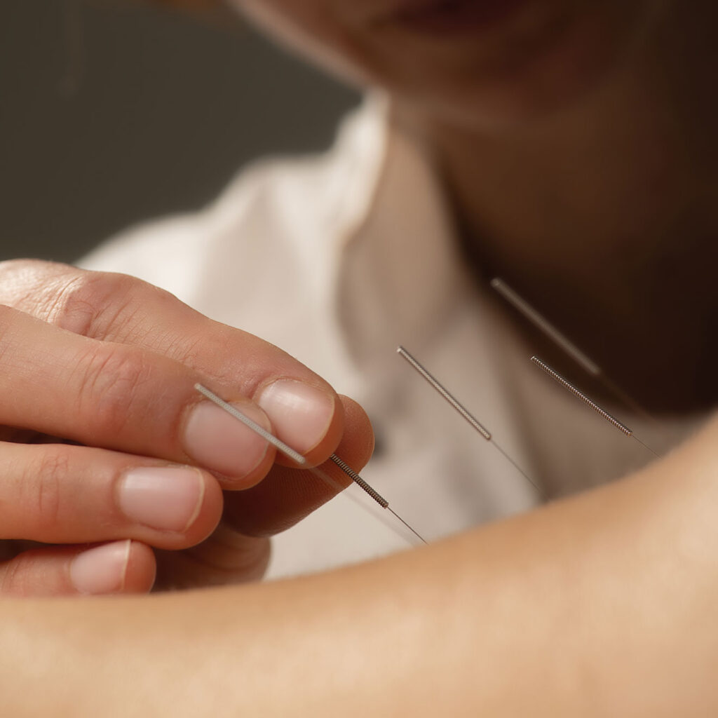 Acupuncture Training for Massage Therapists