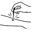 Acupuncture Techniques