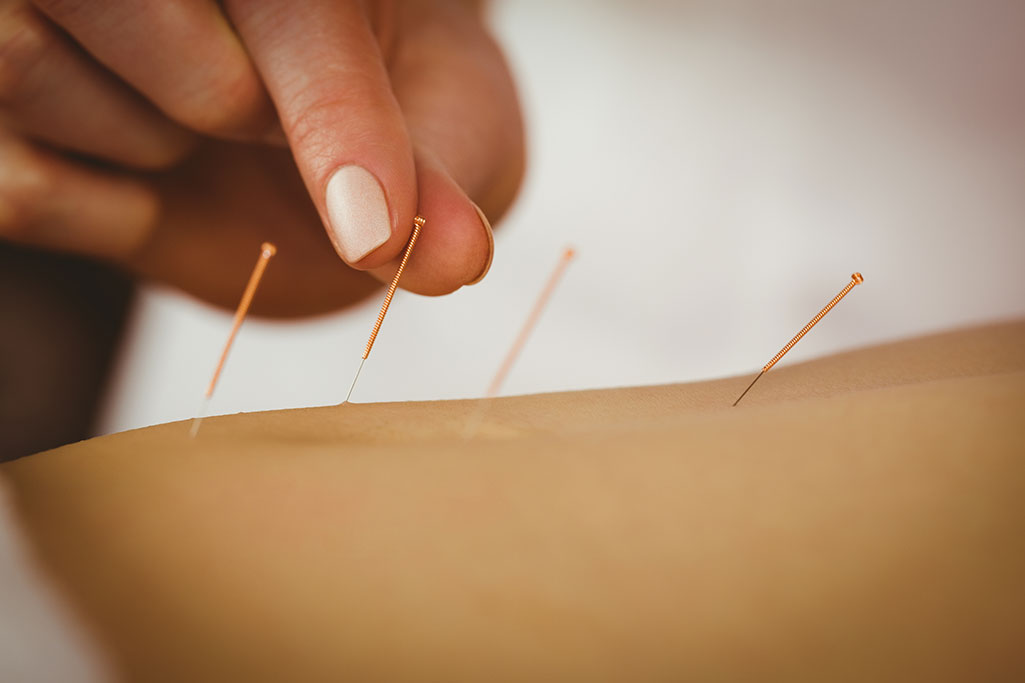 acupuncture-treatment-with-fine-needles-for-therapy