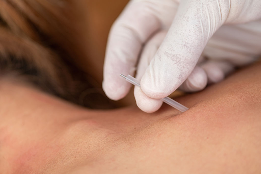 acupuncture-treatment-with-needle-by-healthcare